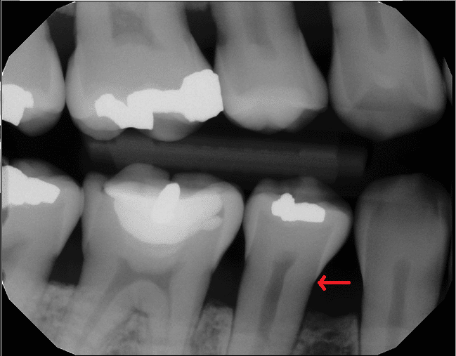 Bone loss - not an invisalign candidate