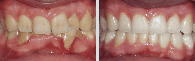 Dental Misalignment - deep bite