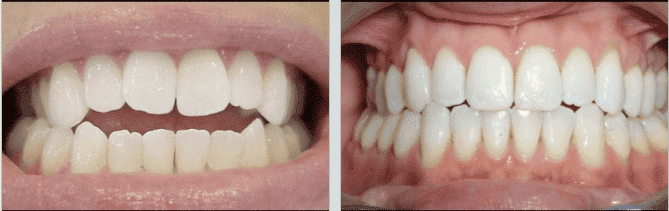 Dental Misalignment - open bite