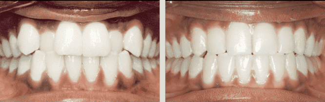 Dental Misalignment - cross bite