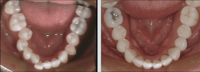 Dental Misalignment - crowding