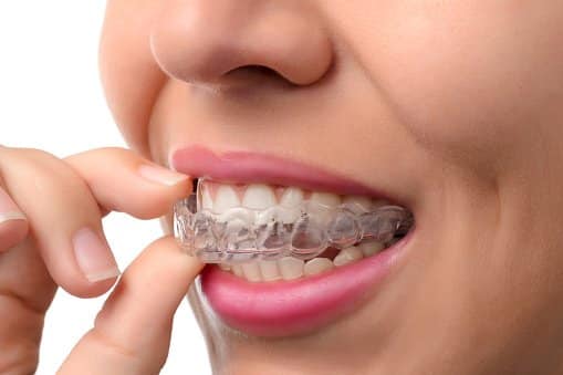 how to choose an invisalign dentist feature