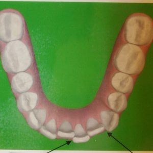 Malocclusion stage 2 -Tribeca Dental Care