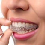 how to choose an invisalign dentist feature